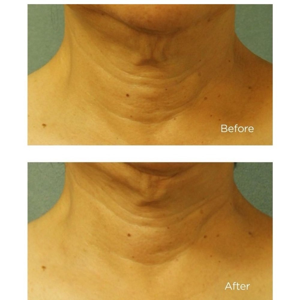 Perricone MD Cold Plasma Plus+ Neck & Chest Broad Spectrum SPF 25 - Picture 4 of 7